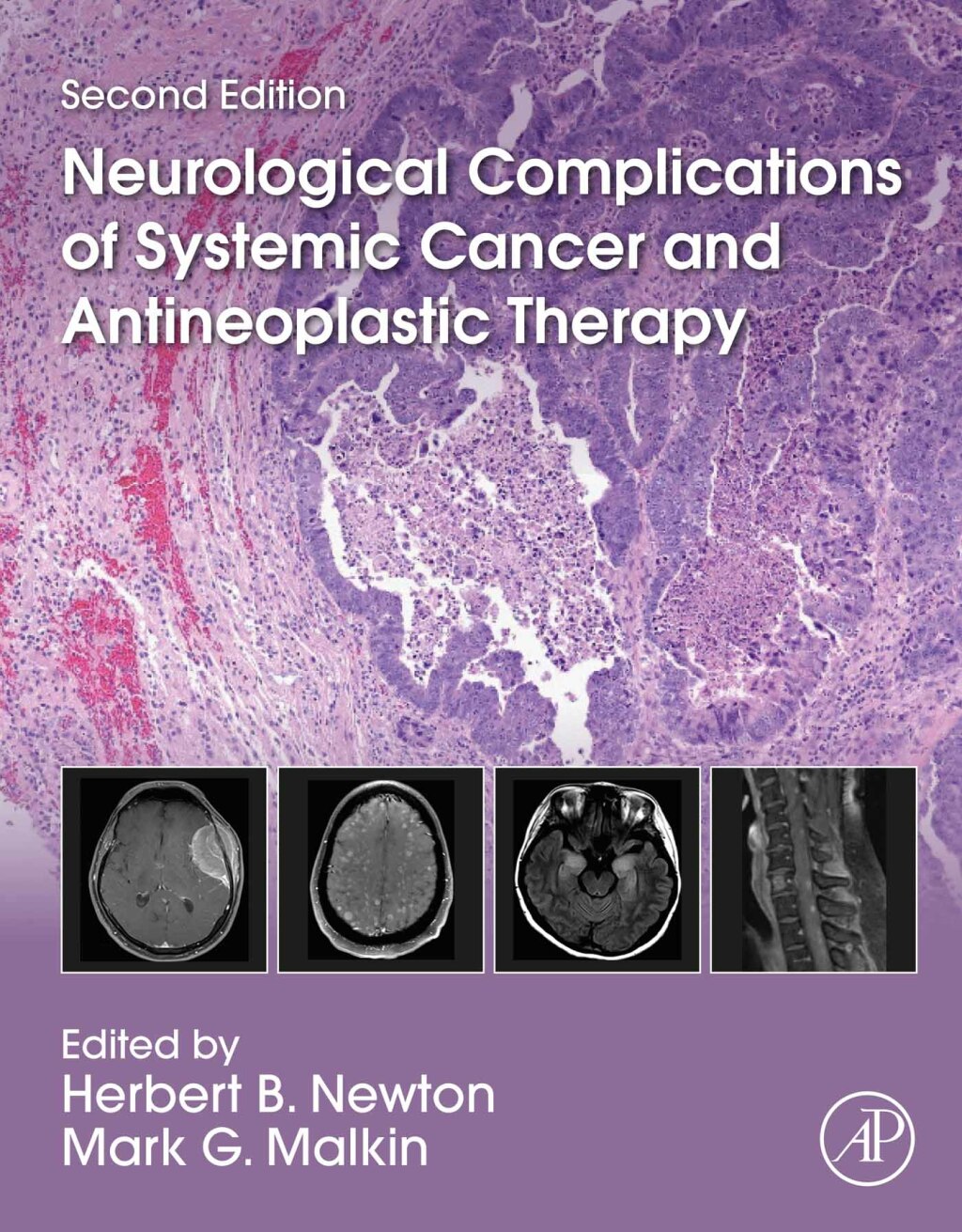 Neurological Complications of Systemic Cancer and Antineoplastic Therapy 2nd Edition â€“ PDF/EPUB Version Downloadable