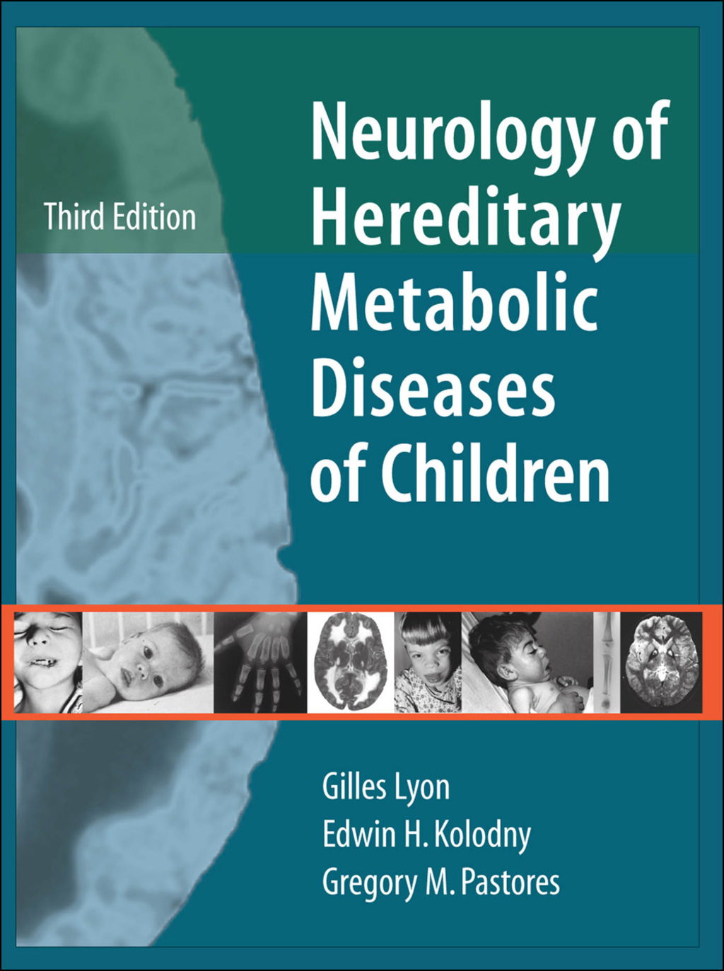 Neurology of Hereditary Metabolic Diseases of Children: Third Edition 3rd Edition â€“ PDF/EPUB Version Downloadable