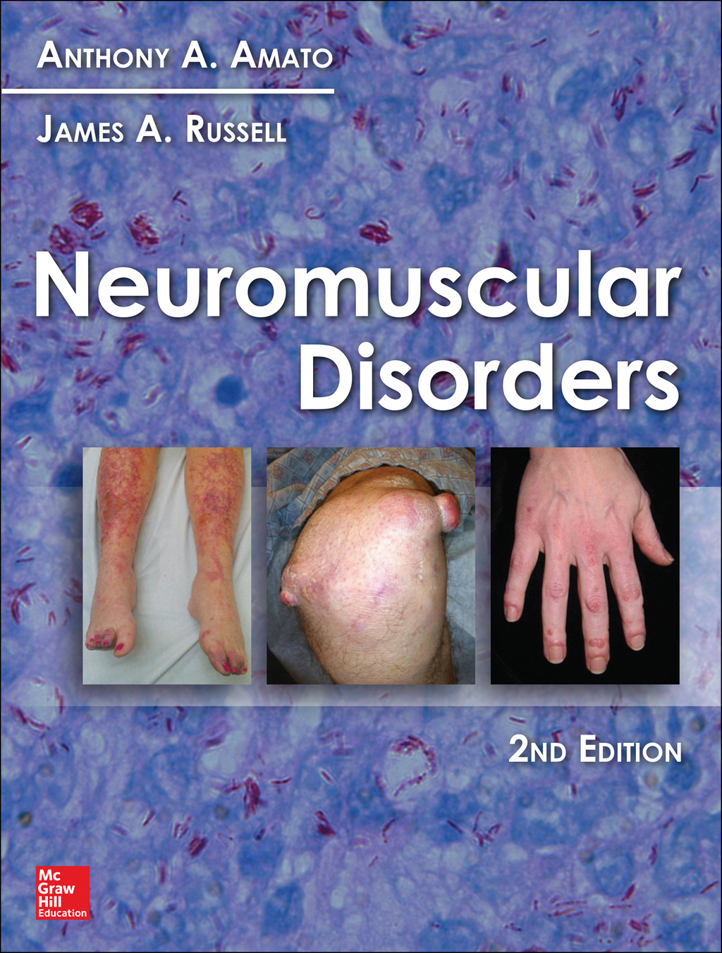 Neuromuscular Disorders, 2nd Edition 2nd Edition â€“ PDF/EPUB Version Downloadable