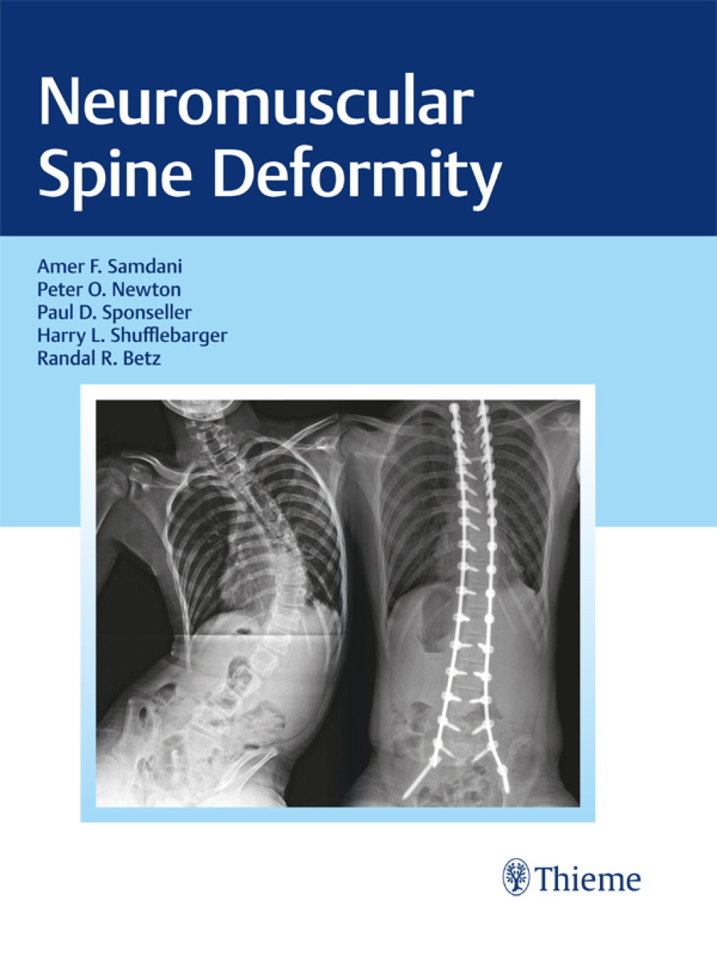 Neuromuscular Spine Deformity 1st Edition â€“ PDF/EPUB Version Downloadable