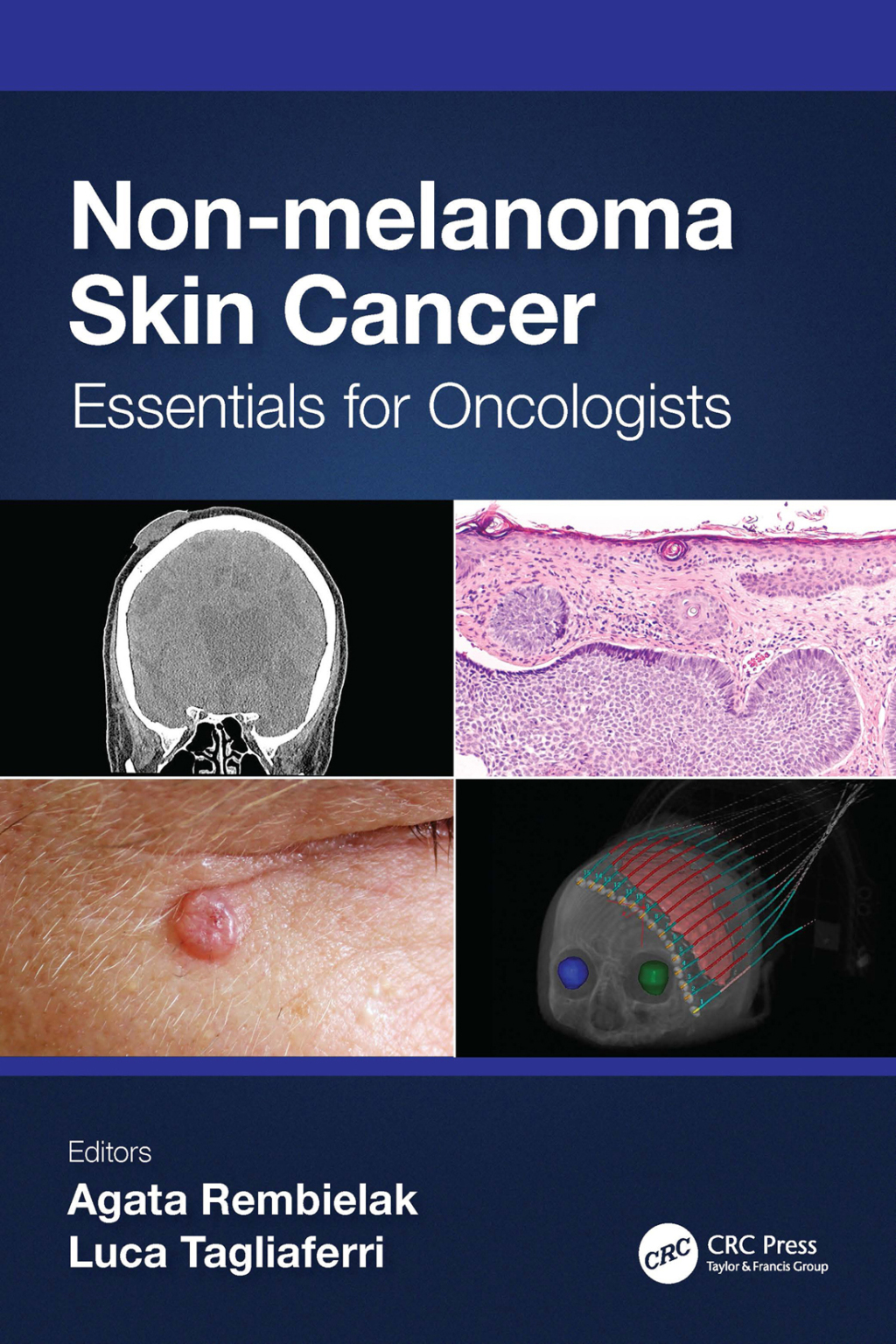 Non-melanoma Skin Cancer Essentials for Oncologists 1st Edition â€“ PDF/EPUB Version Downloadable