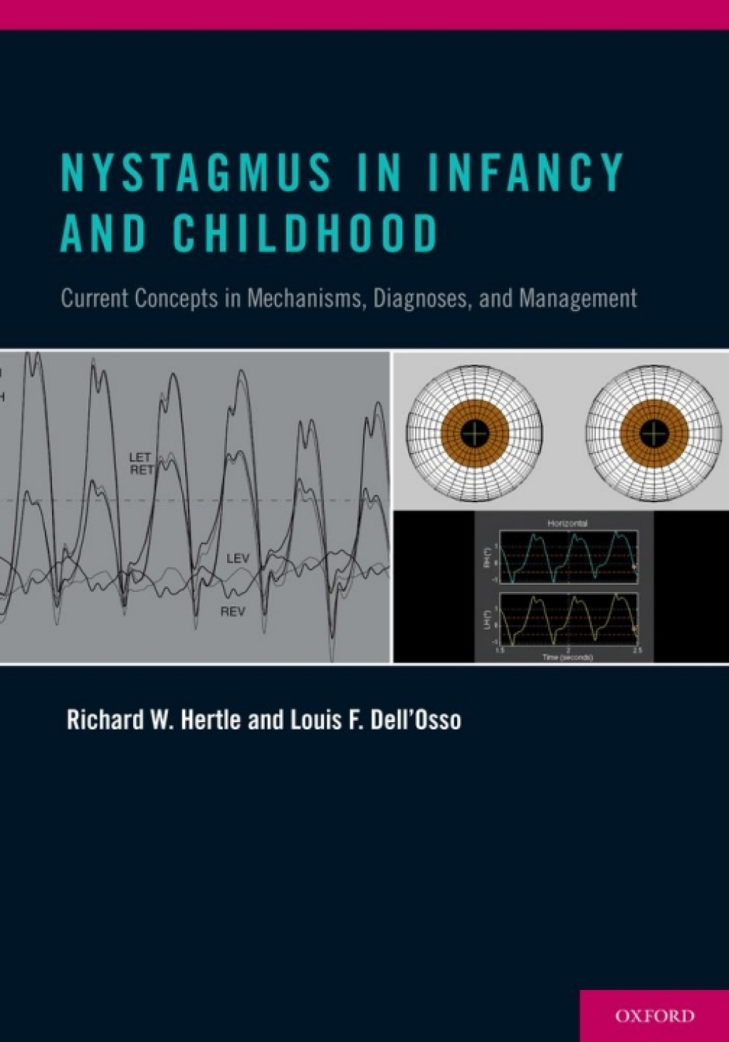 Nystagmus In Infancy and Childhood Current Concepts in Mechanisms, Diagnoses, and Management  â€“ PDF/EPUB Version Downloadable