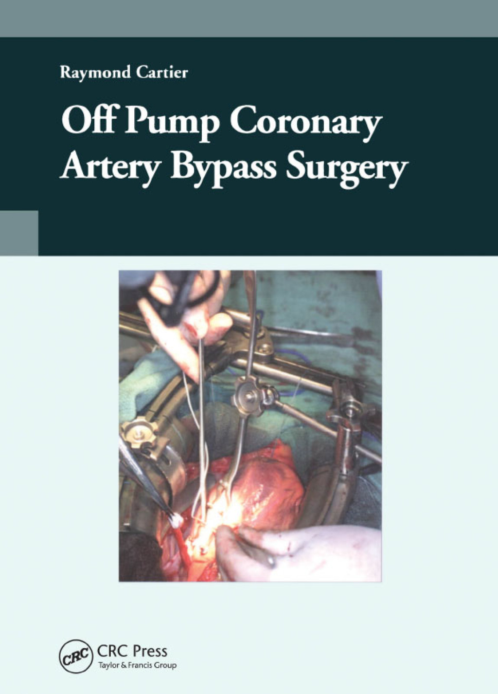Off-Pump Coronary Artery Bypass Surgery 1st Edition â€“ PDF/EPUB Version Downloadable