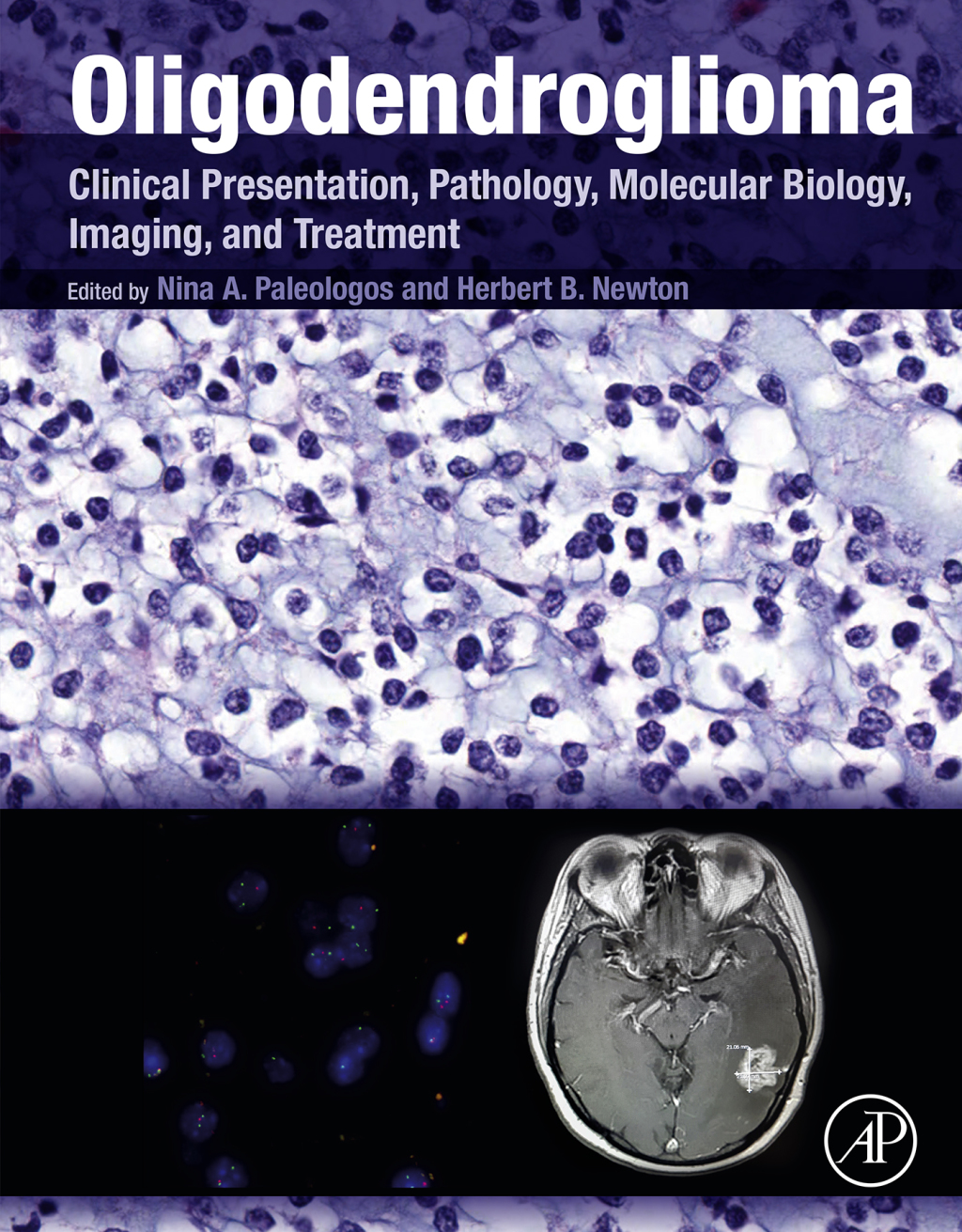 Oligodendroglioma Clinical Presentation, Pathology, Molecular Biology, Imaging, and Treatment  â€“ PDF/EPUB Version Downloadable