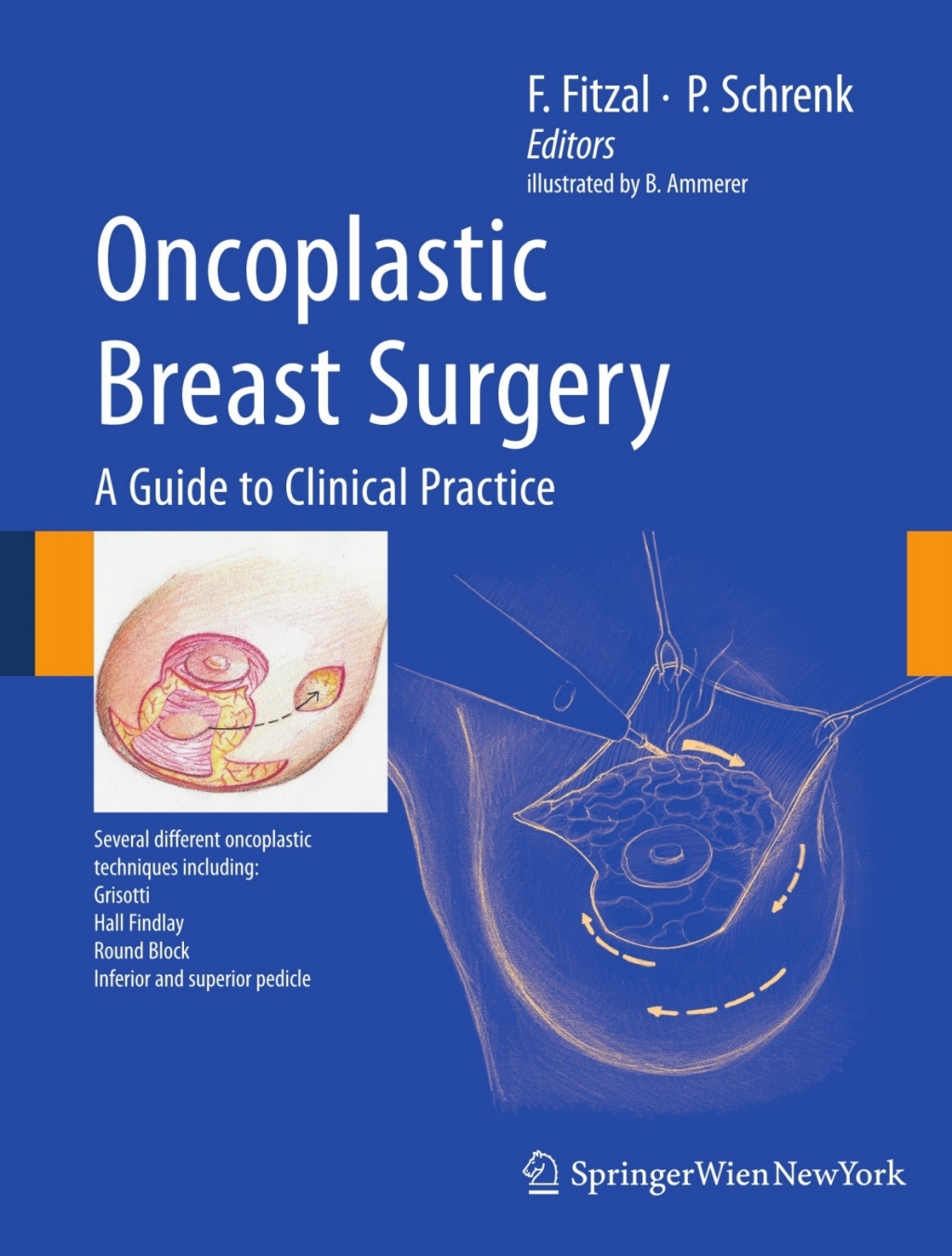Oncoplastic Breast Surgery A Guide to Clinical Practice 1st Edition â€“ PDF/EPUB Version Downloadable