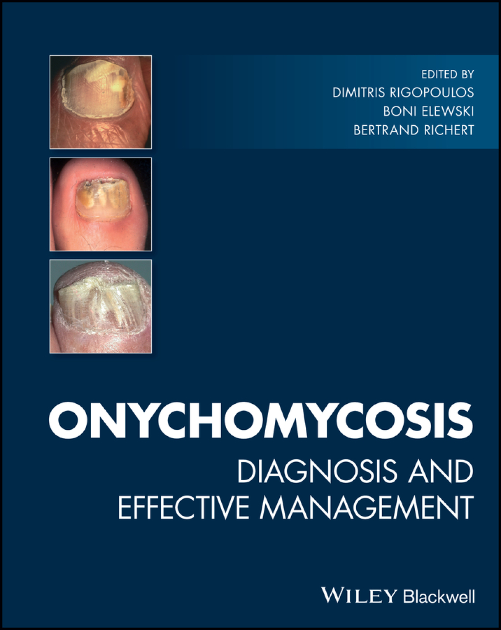 Onychomycosis Diagnosis and Effective Management 1st Edition â€“ PDF/EPUB Version Downloadable
