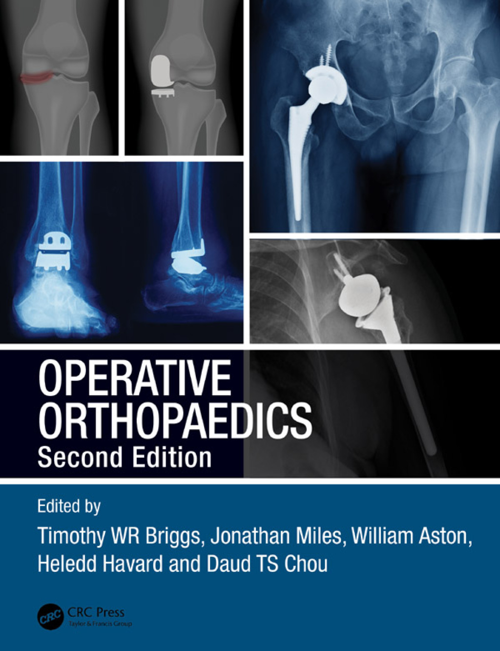 Operative Orthopaedics 2nd Edition â€“ PDF/EPUB Version Downloadable