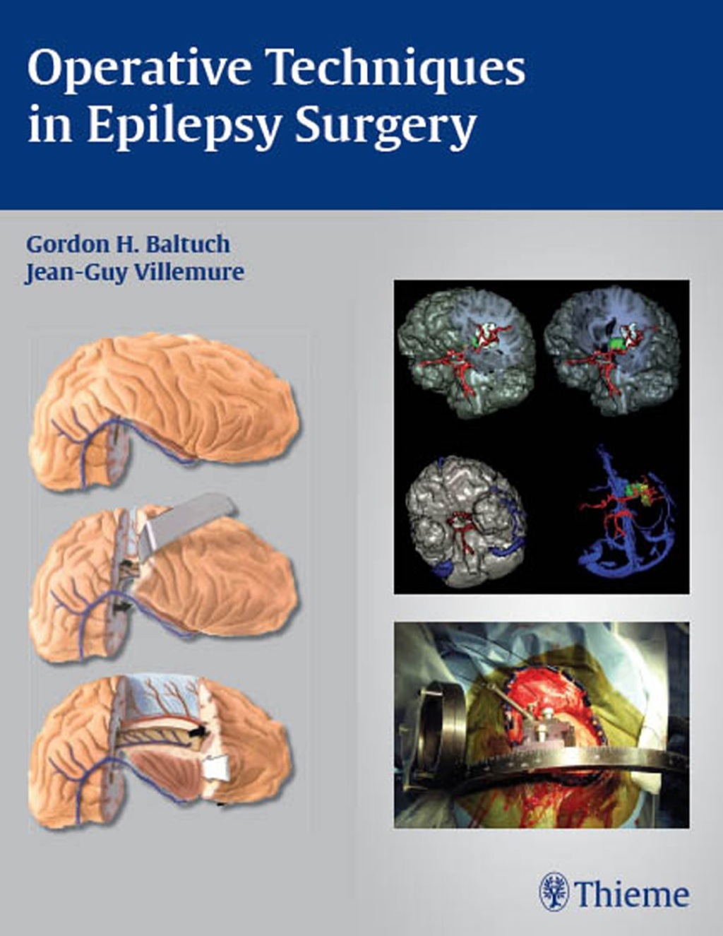 Operative Techniques in Epilepsy Surgery 1st Edition â€“ PDF/EPUB Version Downloadable