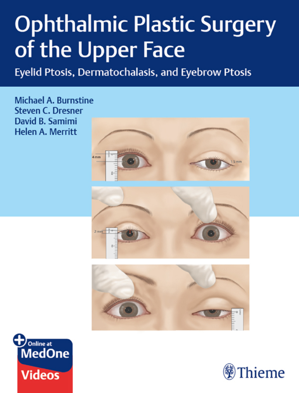 Ophthalmic Plastic Surgery of the Upper Face Eyelid Ptosis, Dermatochalasis, and Eyebrow Ptosis 1st Edition â€“ PDF/EPUB Version Downloadable