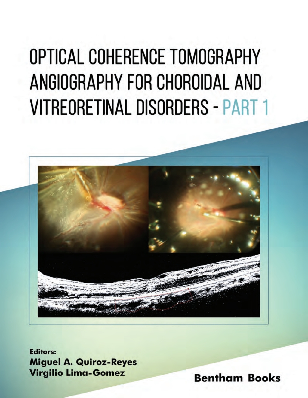 Optical Coherence Tomography Angiography for Choroidal and Vitreoretinal Disorders â€“ Part 1 1st Edition â€“ PDF/EPUB Version Downloadable