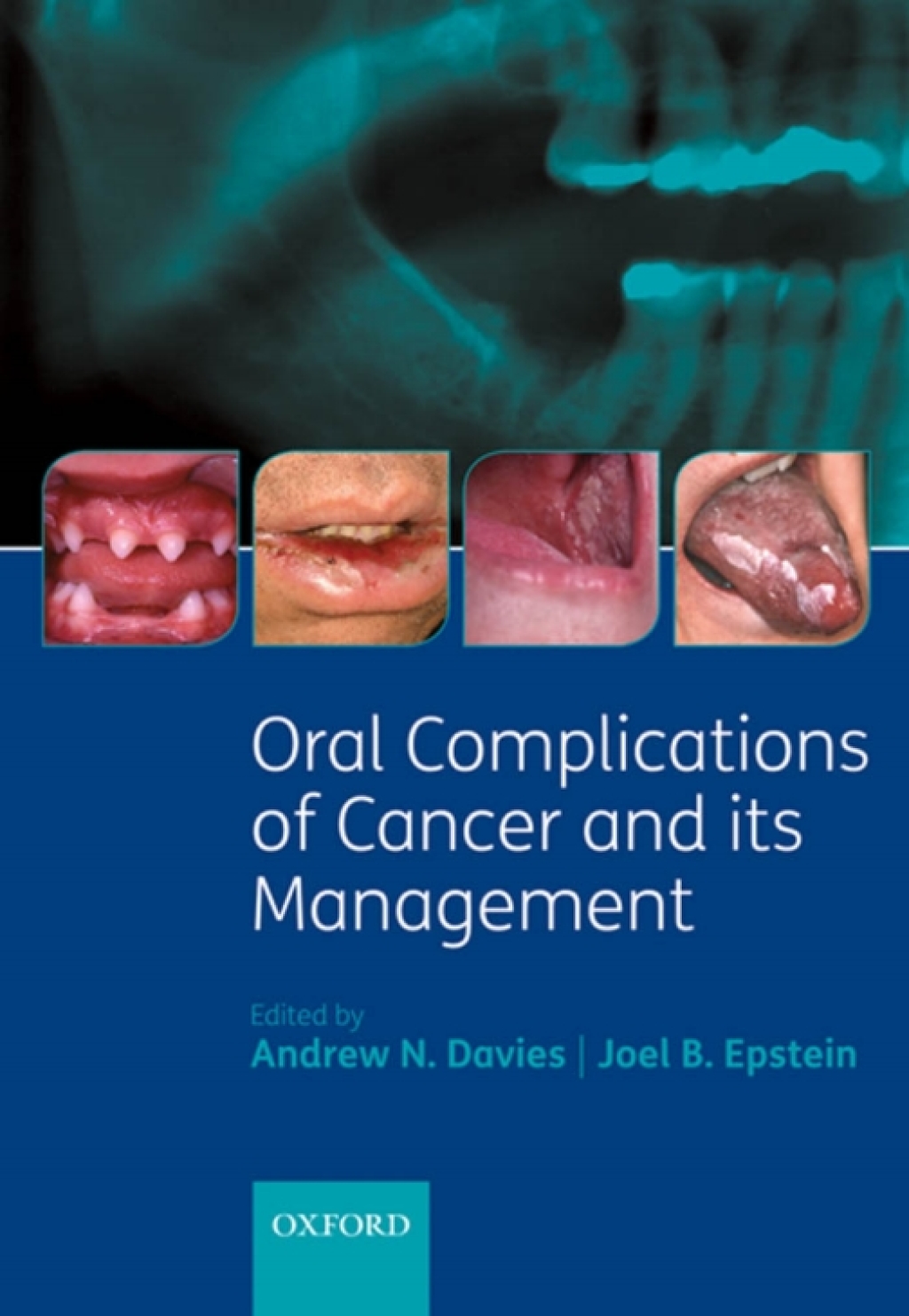 Oral Complications of Cancer and its Management 1st Edition â€“ PDF/EPUB Version Downloadable