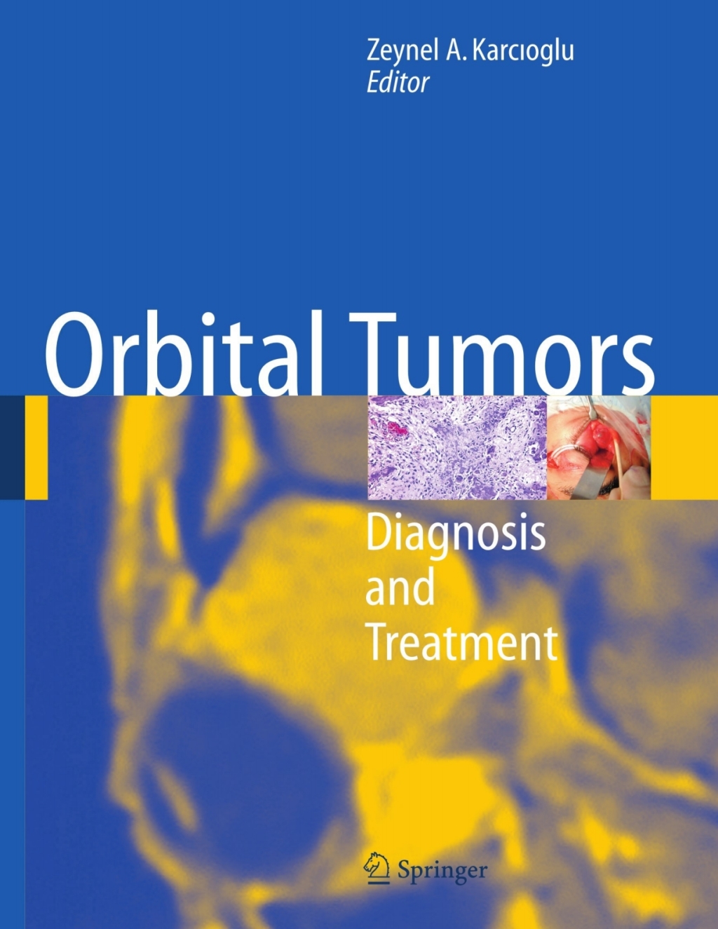 Orbital Tumors Diagnosis and Treatment 1st Edition â€“ PDF/EPUB Version Downloadable
