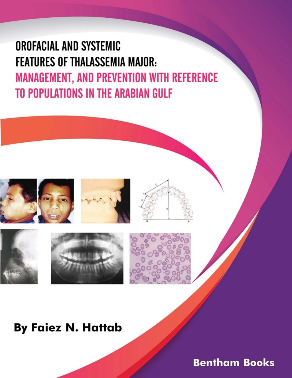 Orofacial and Systemic Features of Thalassemia Major: management, and prevention with reference to populations in the Arabian Gulf 1st Edition â€“ PDF/EPUB Version Downloadable