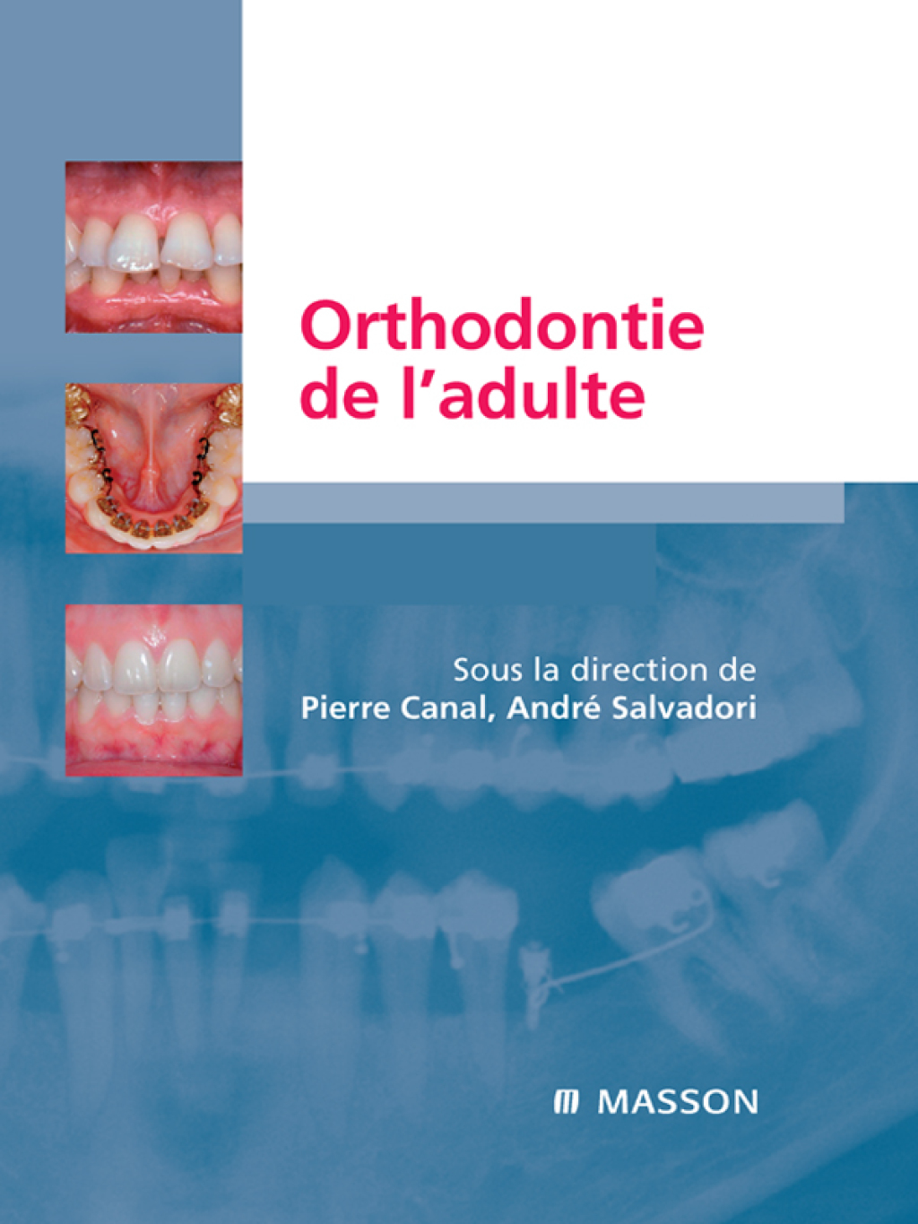 Orthodontie de lâ€™adulte RÃ´le de l'orthodontie dans la rÃ©habilitation gÃ©nÃ©rale de l'adulte  â€“ PDF/EPUB Version Downloadable