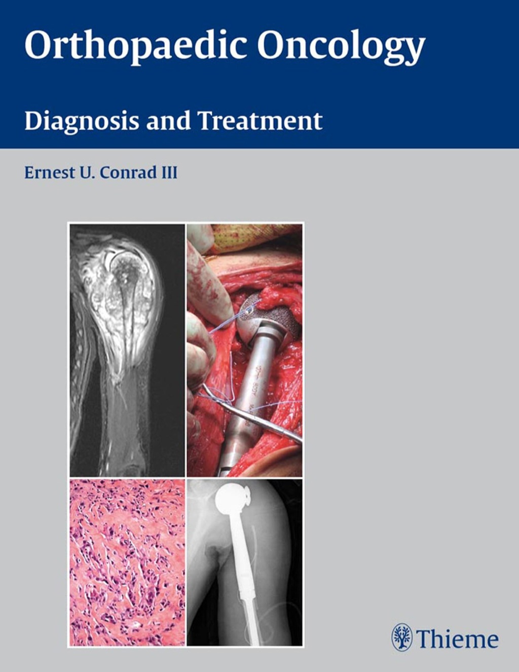 Orthopaedic Oncology Diagnosis and Treatment 1st Edition â€“ PDF/EPUB Version Downloadable