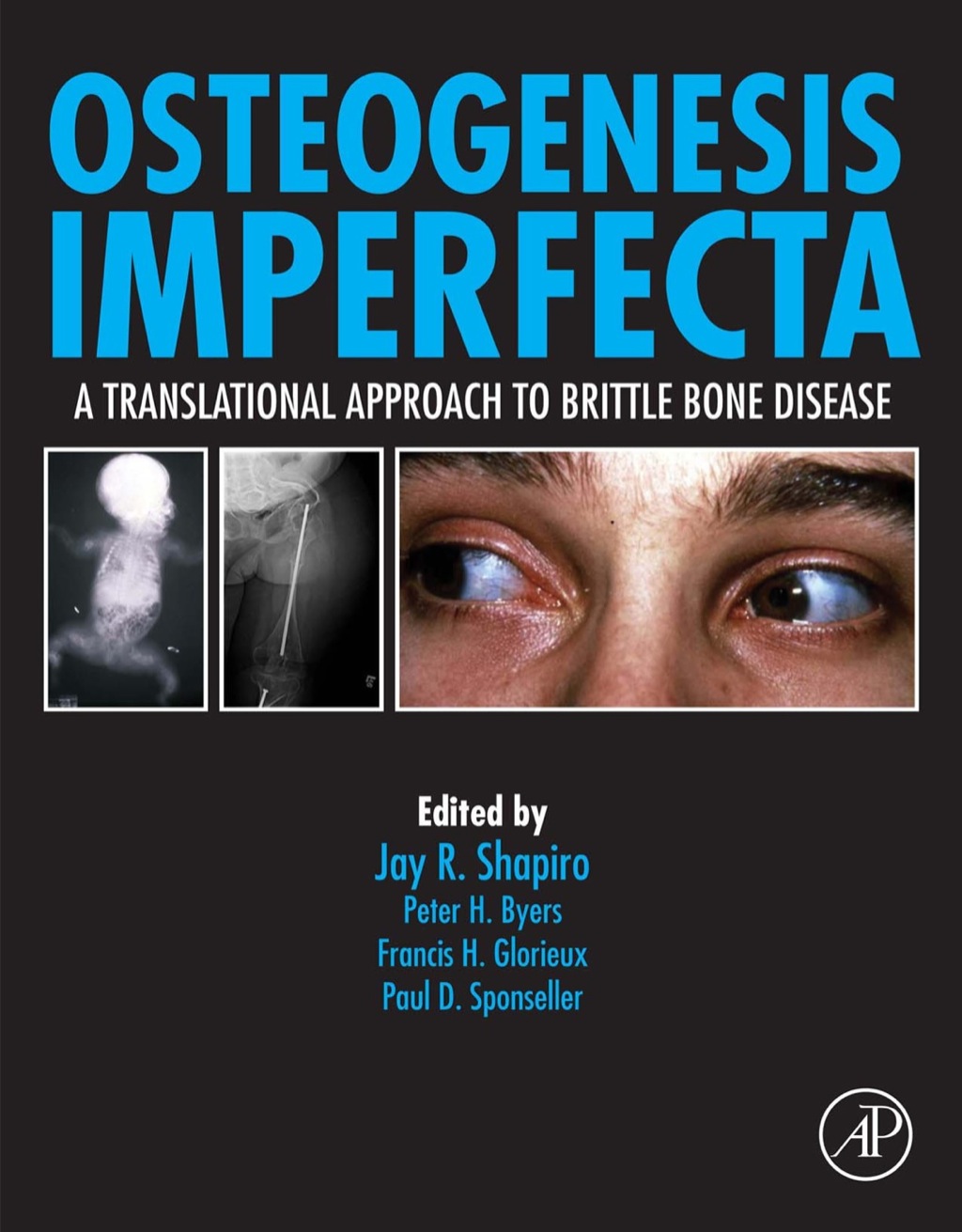 Osteogenesis Imperfecta: A Translational Approach to Brittle Bone Disease  â€“ PDF/EPUB Version Downloadable