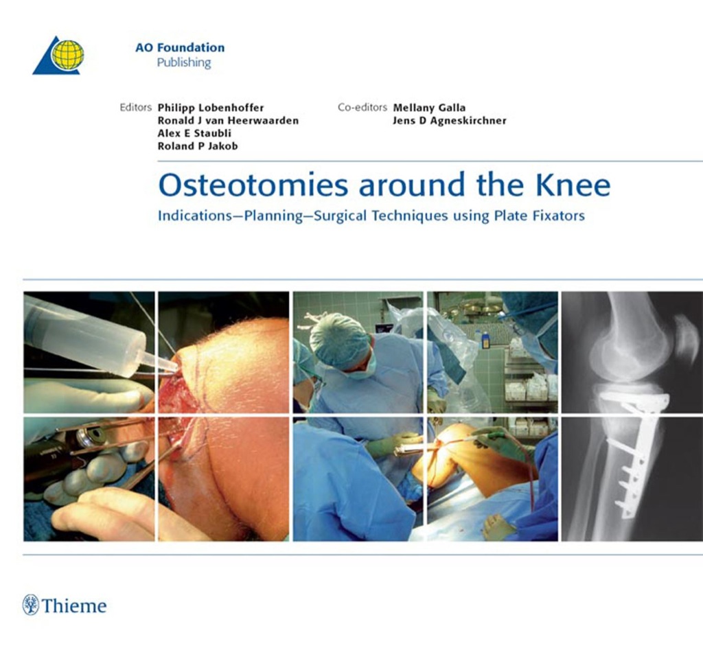 Osteotomies around the Knee Indications - Planning - Surgical Techniques using Plate Fixators 1st Edition â€“ PDF/EPUB Version Downloadable