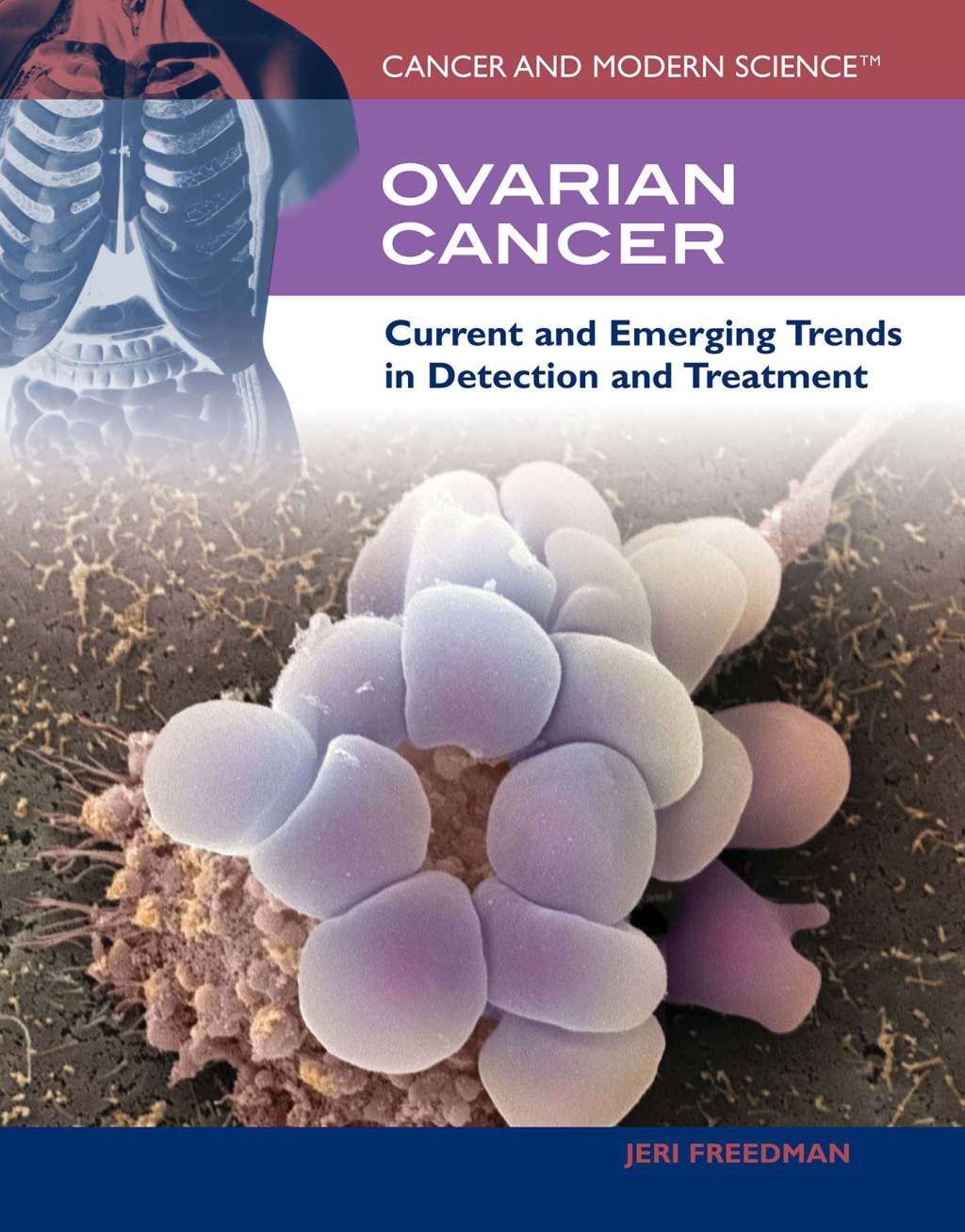 Ovarian Cancer  â€“ PDF/EPUB Version Downloadable