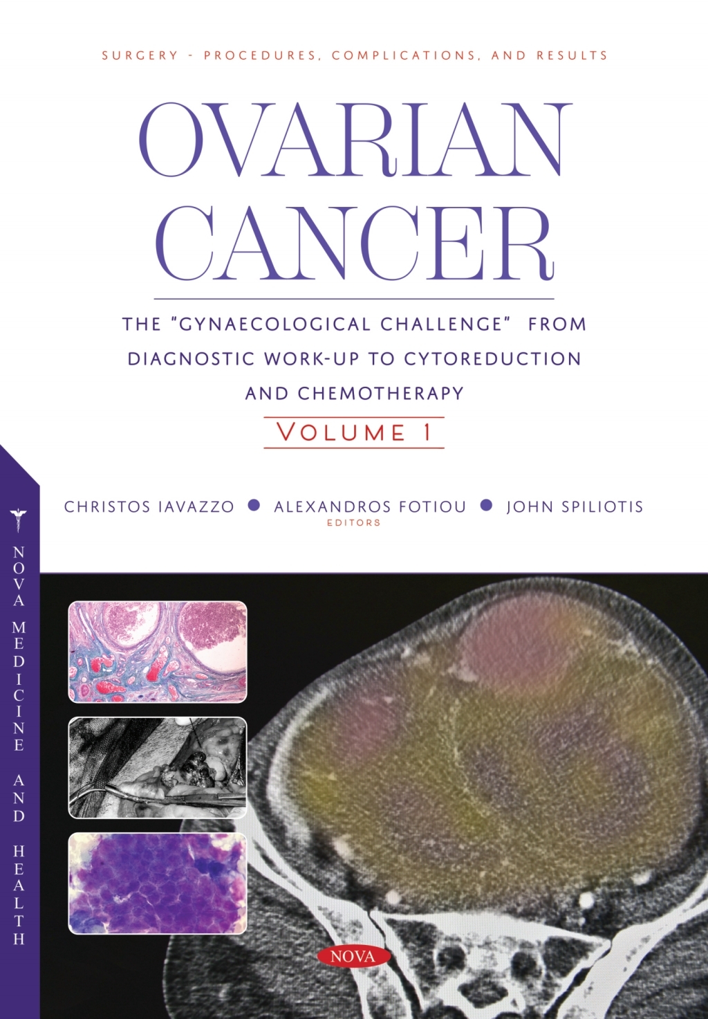 Ovarian Cancer: The â€œGynaecological Challengeâ€ from Diagnostic Work-Up to Cytoreduction and Chemotherapy. Volume 1  â€“ PDF/EPUB Version Downloadable