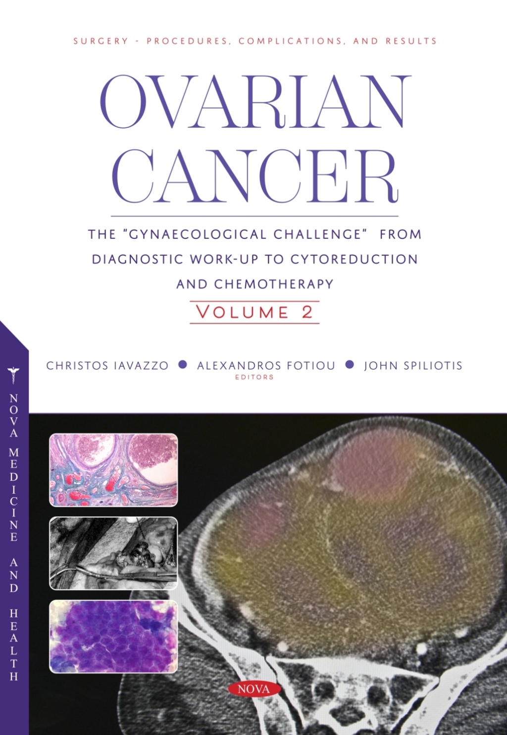 Ovarian Cancer: The â€œGynaecological Challengeâ€ from Diagnostic Work-Up to Cytoreduction and Chemotherapy. Volume 2  â€“ PDF/EPUB Version Downloadable