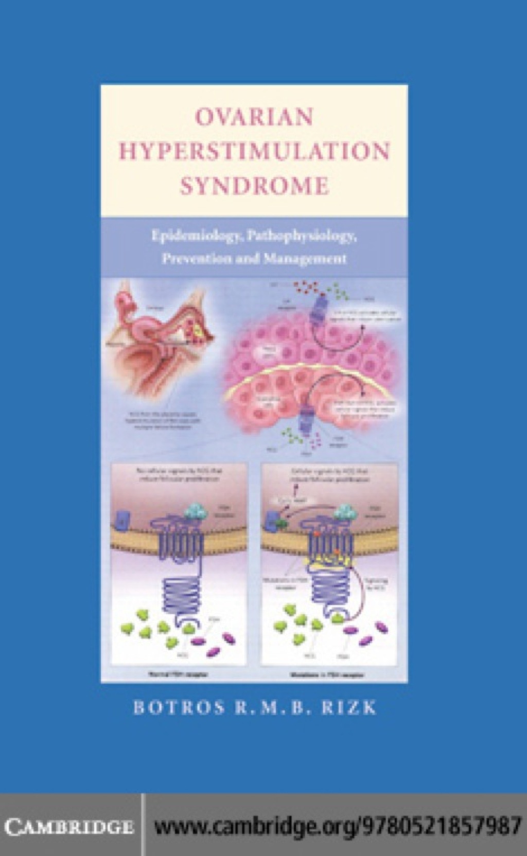 Ovarian Hyperstimulation Syndrome Epidemiology, Pathophysiology, Prevention and Management 1st Edition â€“ PDF/EPUB Version Downloadable