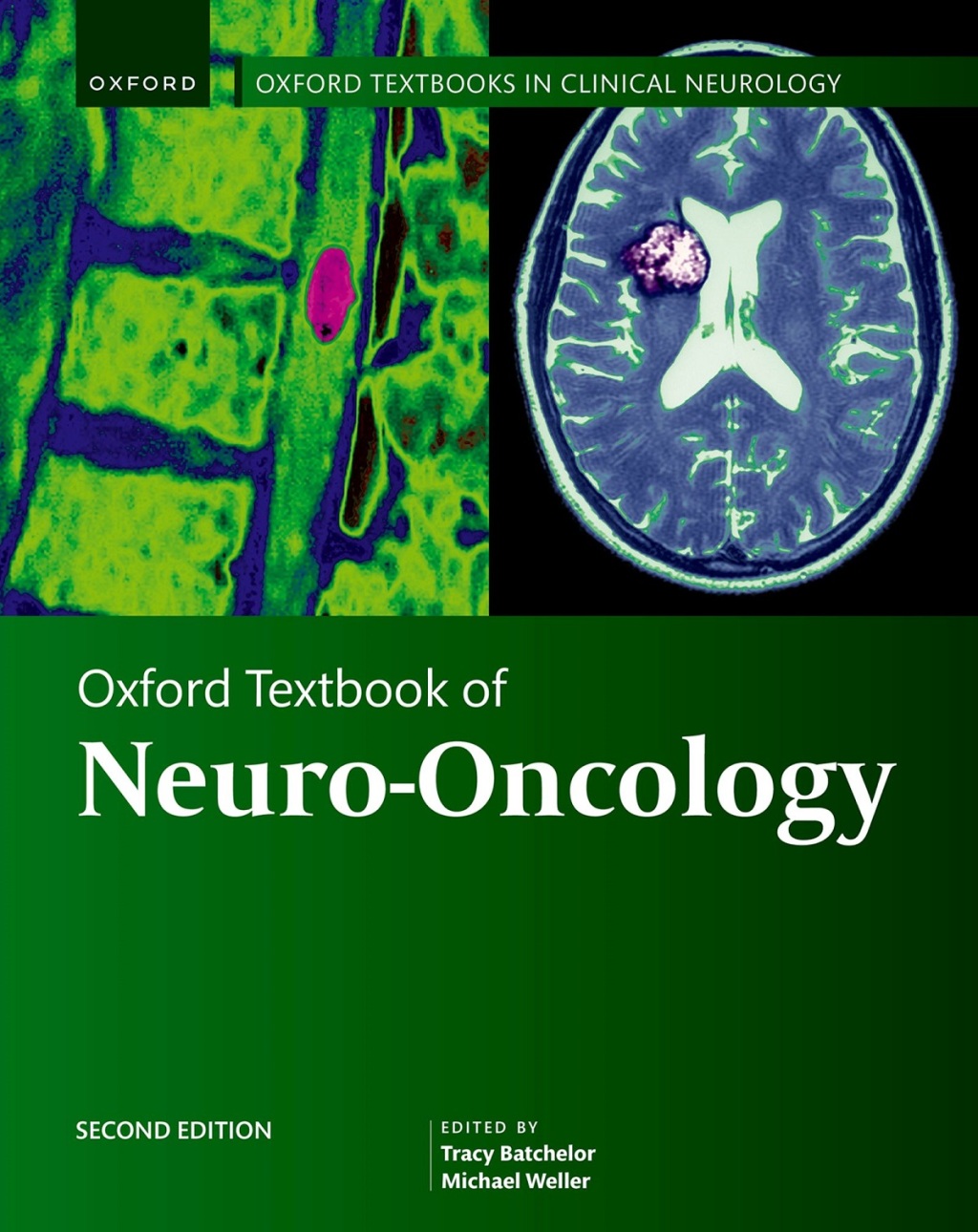Oxford Textbook of Neuro-Oncology 2nd Edition â€“ PDF/EPUB Version Downloadable