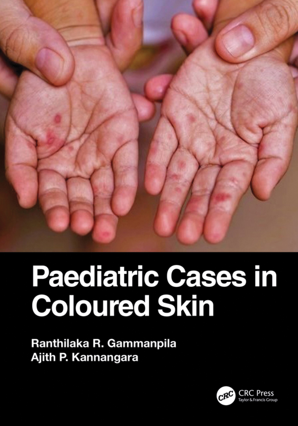 Paediatric Cases in Coloured Skin 1st Edition â€“ PDF/EPUB Version Downloadable