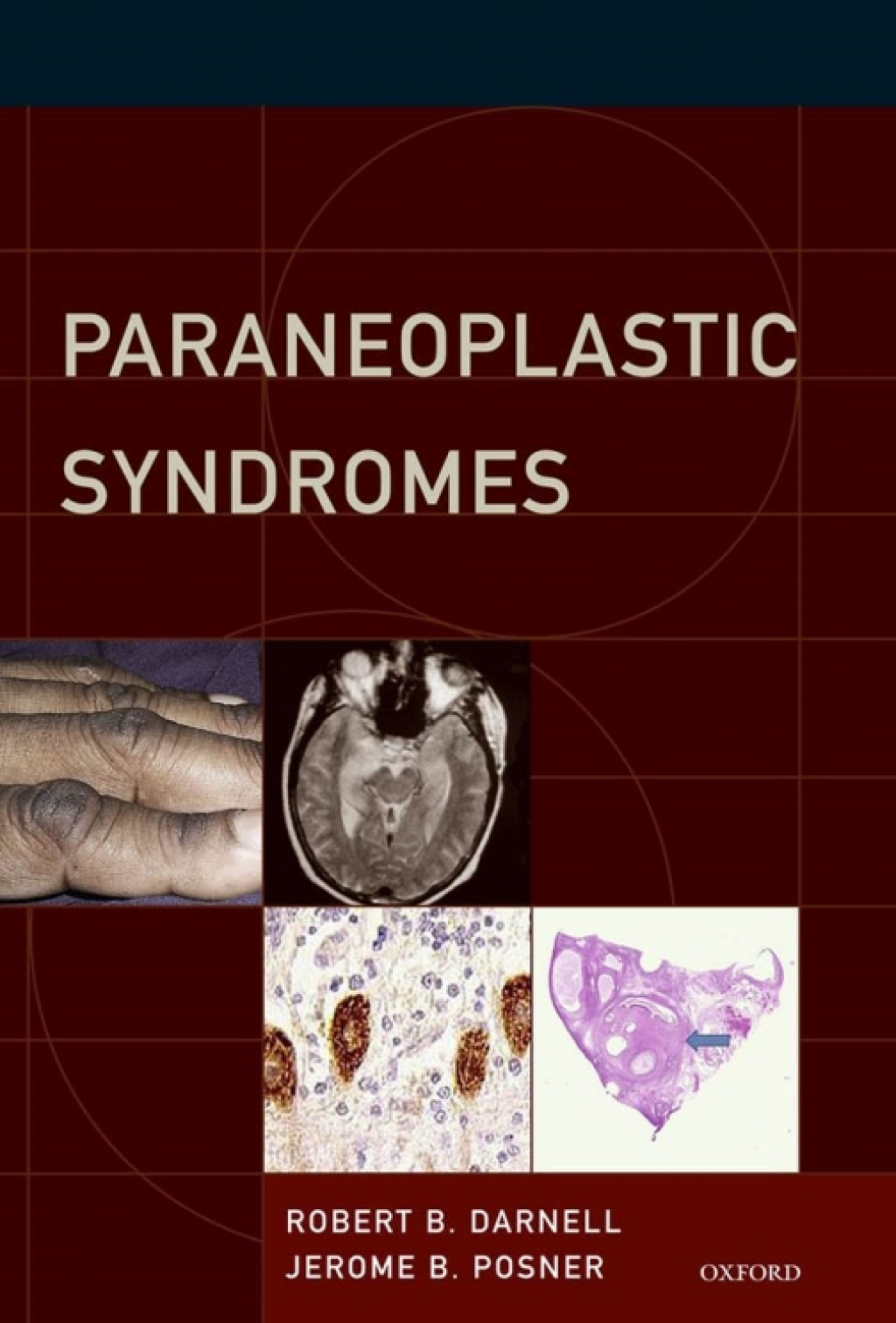 Paraneoplastic Syndromes  â€“ PDF/EPUB Version Downloadable