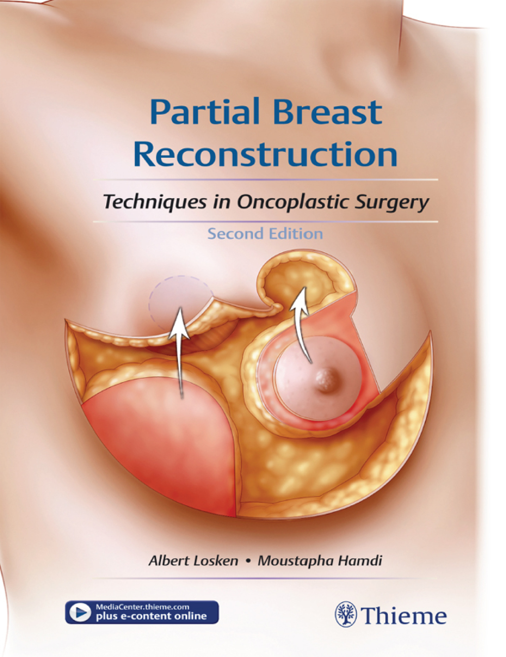 Partial Breast Reconstruction Techniques in Oncoplastic Surgery 2nd Edition â€“ PDF/EPUB Version Downloadable