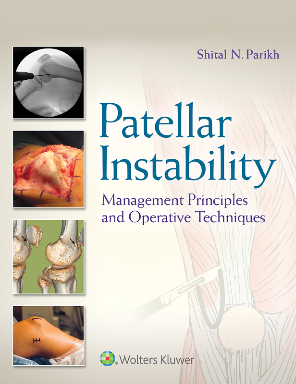 Patellar Instability Management Principles and Operative Techniques  â€“ PDF/EPUB Version Downloadable