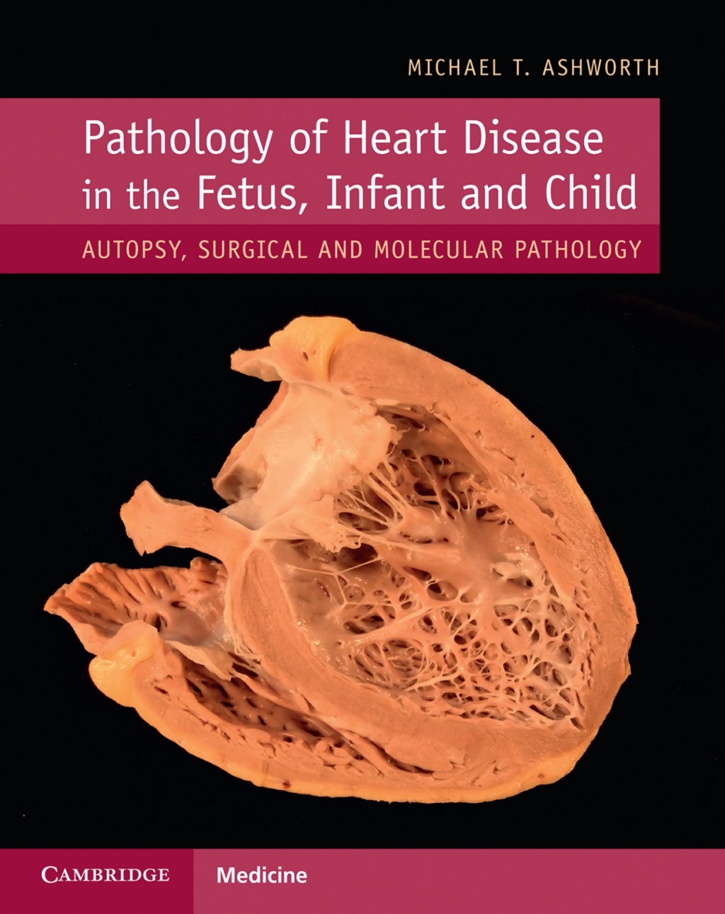 Pathology of Heart Disease in the Fetus, Infant and Child Autopsy, Surgical and Molecular Pathology  â€“ PDF/EPUB Version Downloadable