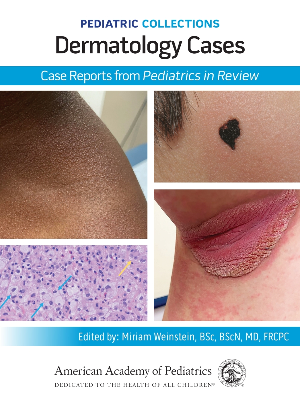 Pediatric Collections: Dermatology Cases: Case Reports from Pediatrics in Review  â€“ PDF/EPUB Version Downloadable