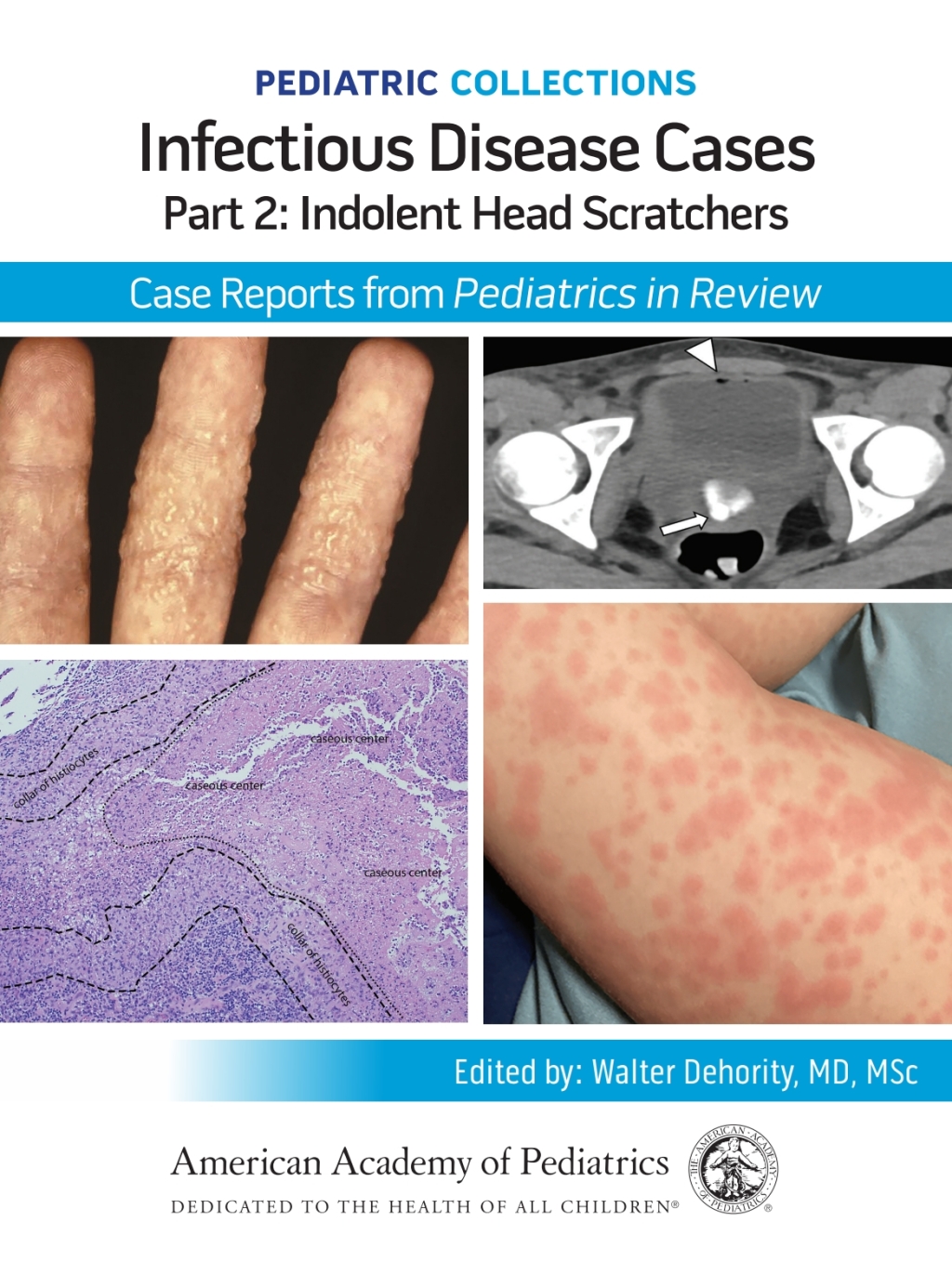 Pediatric Collections: Infectious Disease Cases: Part 2: Indolent Head Scratchers: Case Reports from Pediatrics in Review  â€“ PDF/EPUB Version Downloadable
