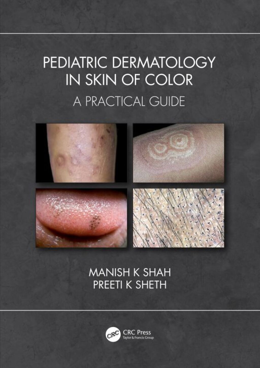 Pediatric Dermatology in Skin of Color A Practical Guide 1st Edition â€“ PDF/EPUB Version Downloadable