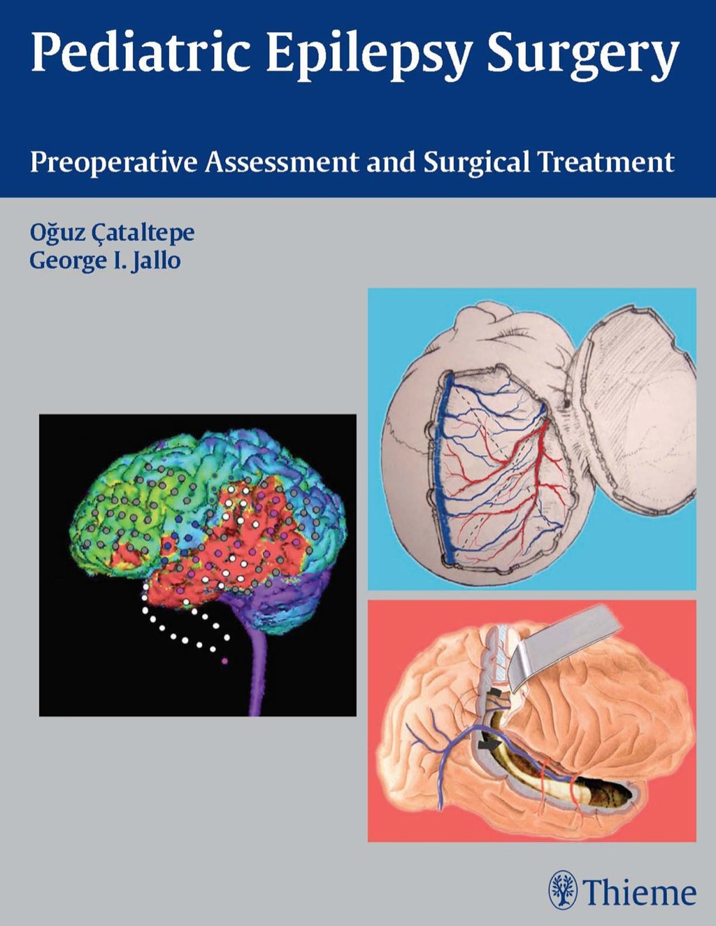 Pediatric Epilepsy Surgery Preoperative Assessment and Surgical Treatment 1st Edition â€“ PDF/EPUB Version Downloadable