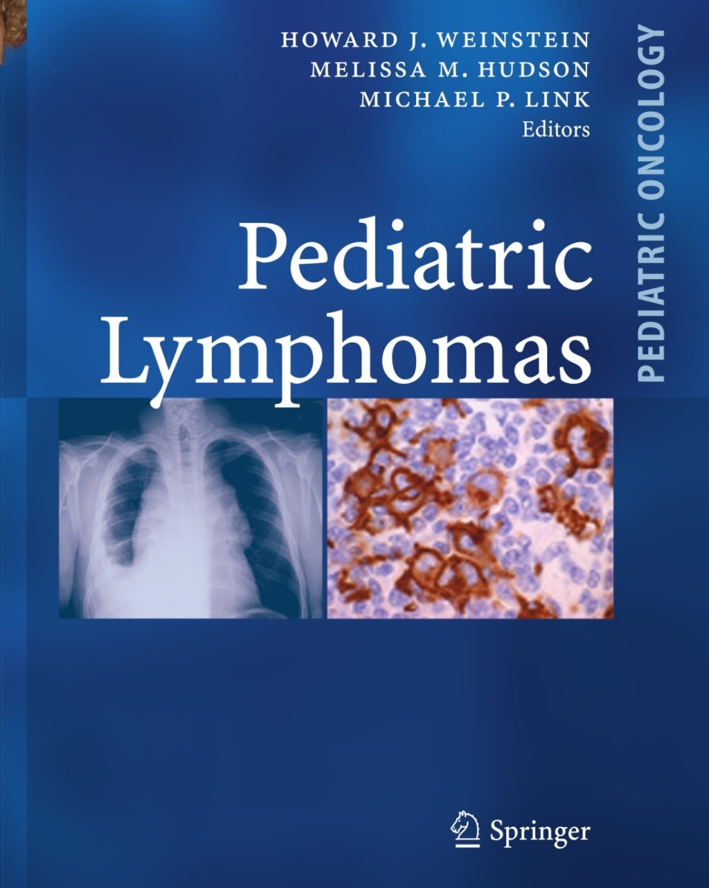 Pediatric Lymphomas 1st Edition â€“ PDF/EPUB Version Downloadable