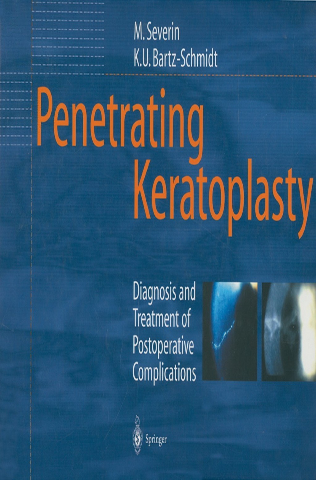Penetrating Keratoplasty Diagnosis and Treatment of Postoperative Complications  â€“ PDF/EPUB Version Downloadable