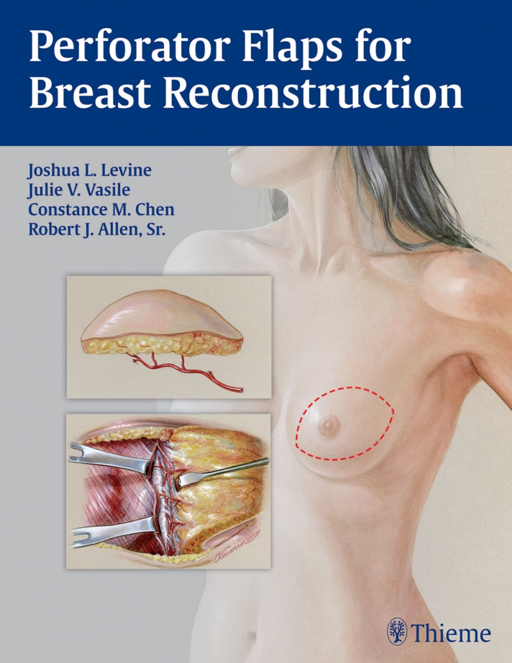Perforator Flaps for Breast Reconstruction 1st Edition â€“ PDF/EPUB Version Downloadable