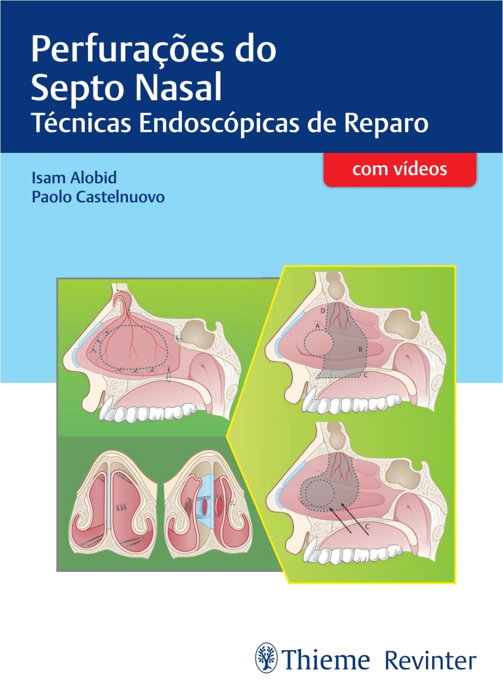 PerfuraÃ§Ãµes do Septo Nasal: TÃ©cnicas EndoscÃ³picas de Reparo 1st Edition â€“ PDF/EPUB Version Downloadable