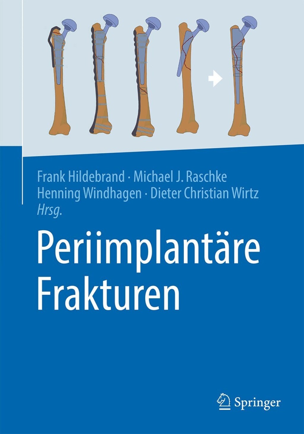 PeriimplantÃ¤re Frakturen  â€“ PDF/EPUB Version Downloadable