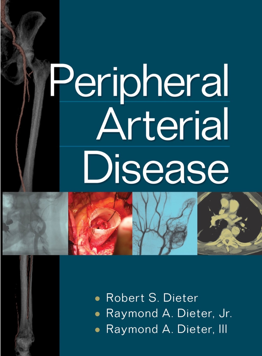 Peripheral Arterial Disease 1st Edition â€“ PDF/EPUB Version Downloadable