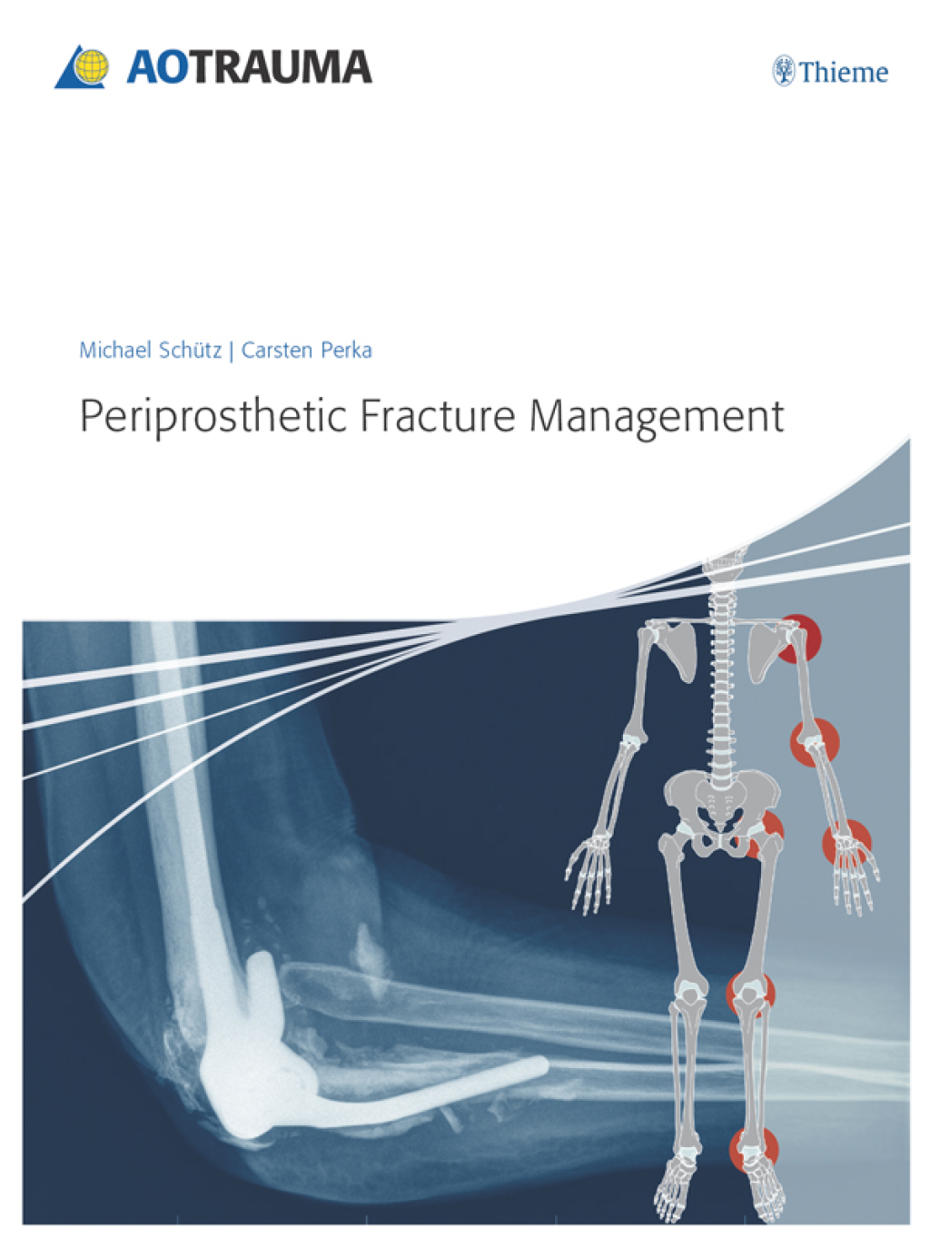 Periprosthetic Fracture Management 1st Edition â€“ PDF/EPUB Version Downloadable