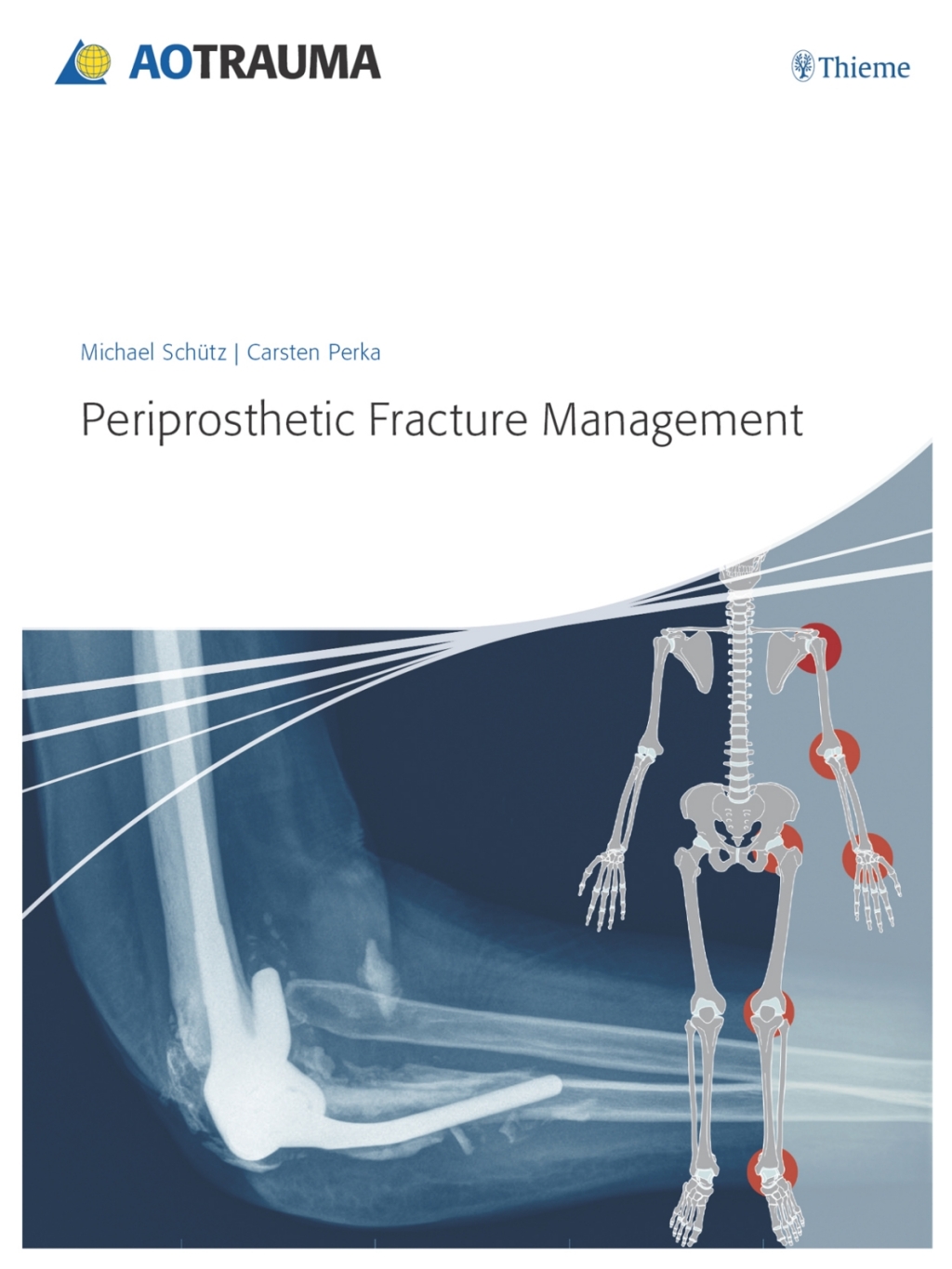 Periprosthetic Fracture Management 1st Edition â€“ PDF/EPUB Version Downloadable