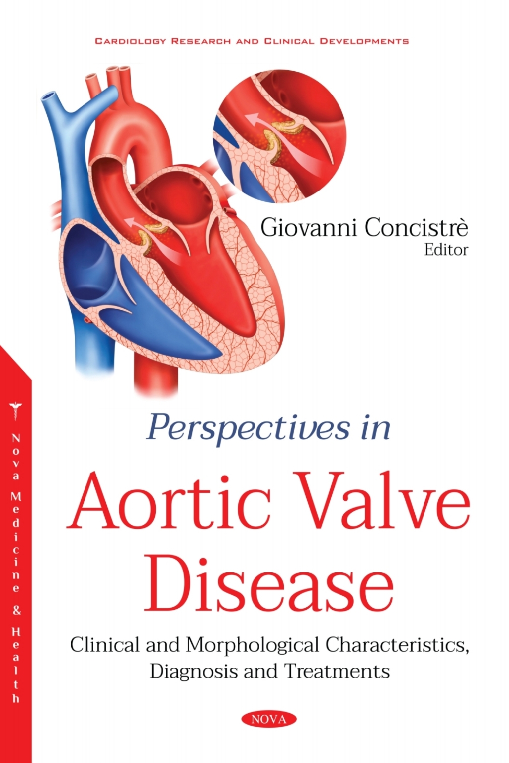 Perspectives in Aortic Valve Disease: Clinical and Morphological Characteristics, Diagnosis and Treatments  â€“ PDF/EPUB Version Downloadable