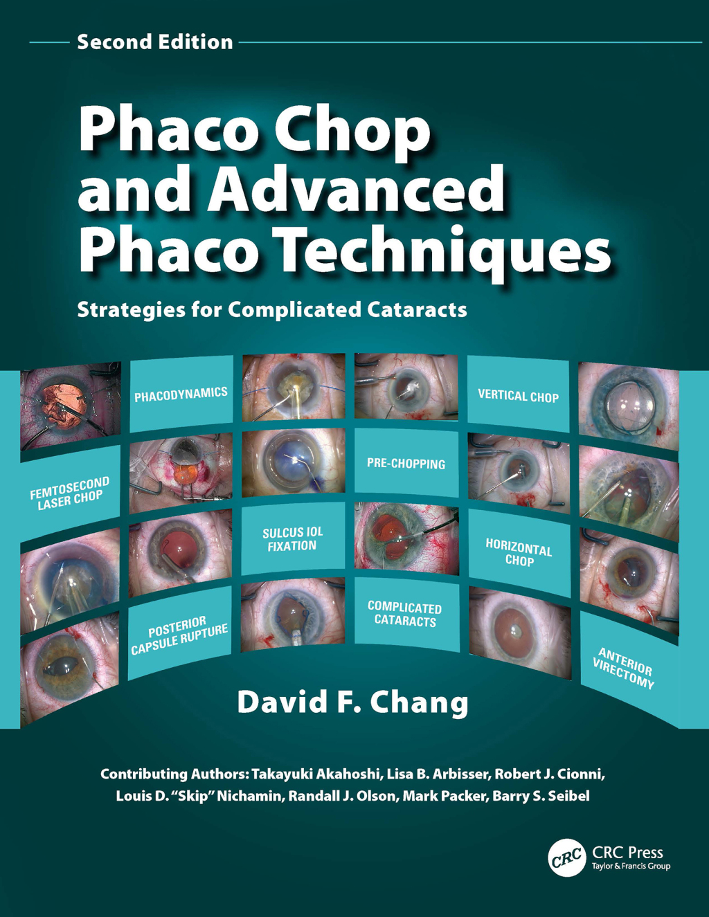 Phaco Chop and Advanced Phaco Techniques Strategies for Complicated Cataracts 2nd Edition â€“ PDF/EPUB Version Downloadable