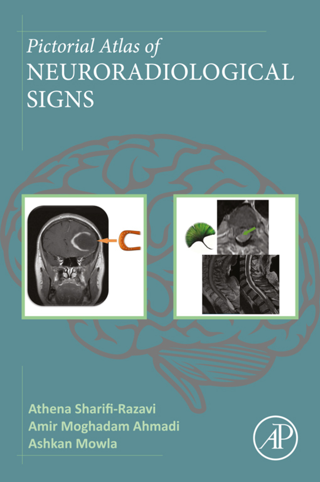 Pictorial Atlas of Neuroradiological Signs 1st Edition â€“ PDF/EPUB Version Downloadable