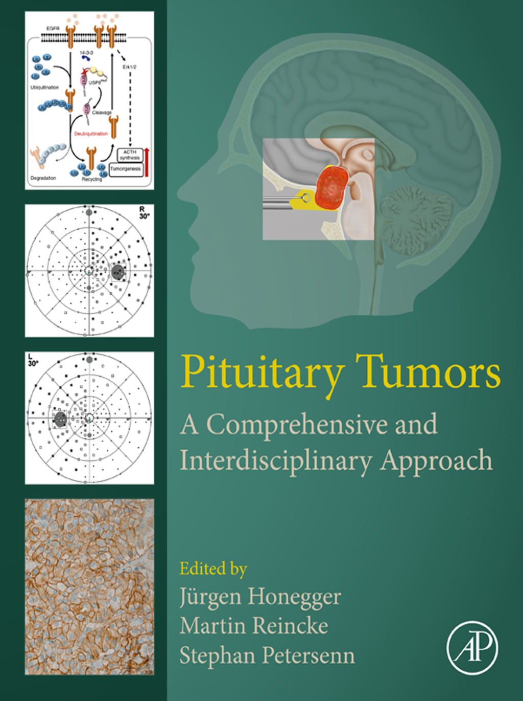 Pituitary Tumors A Comprehensive and Interdisciplinary Approach  â€“ PDF/EPUB Version Downloadable