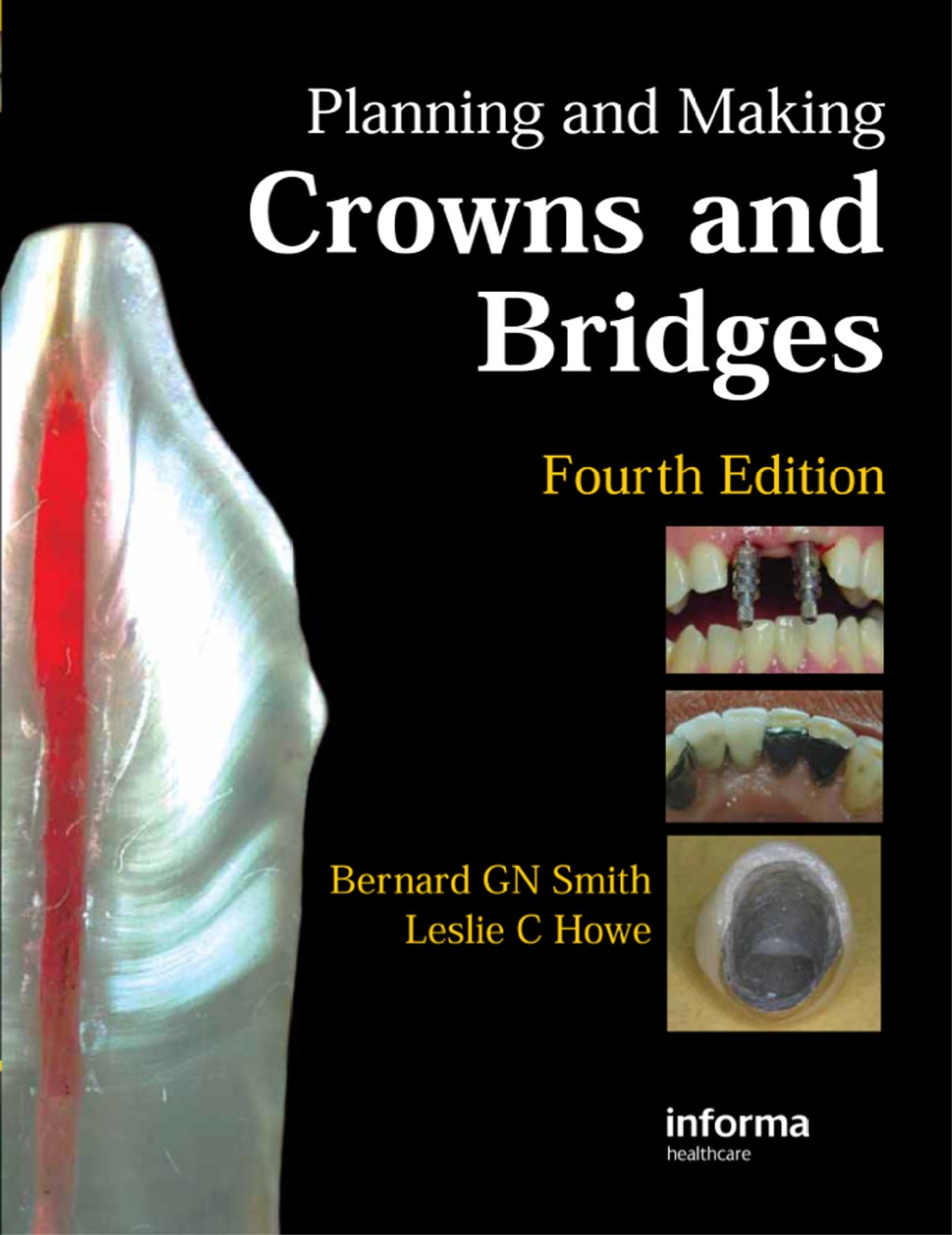 Planning and Making Crowns and Bridges 4th Edition â€“ PDF/EPUB Version Downloadable