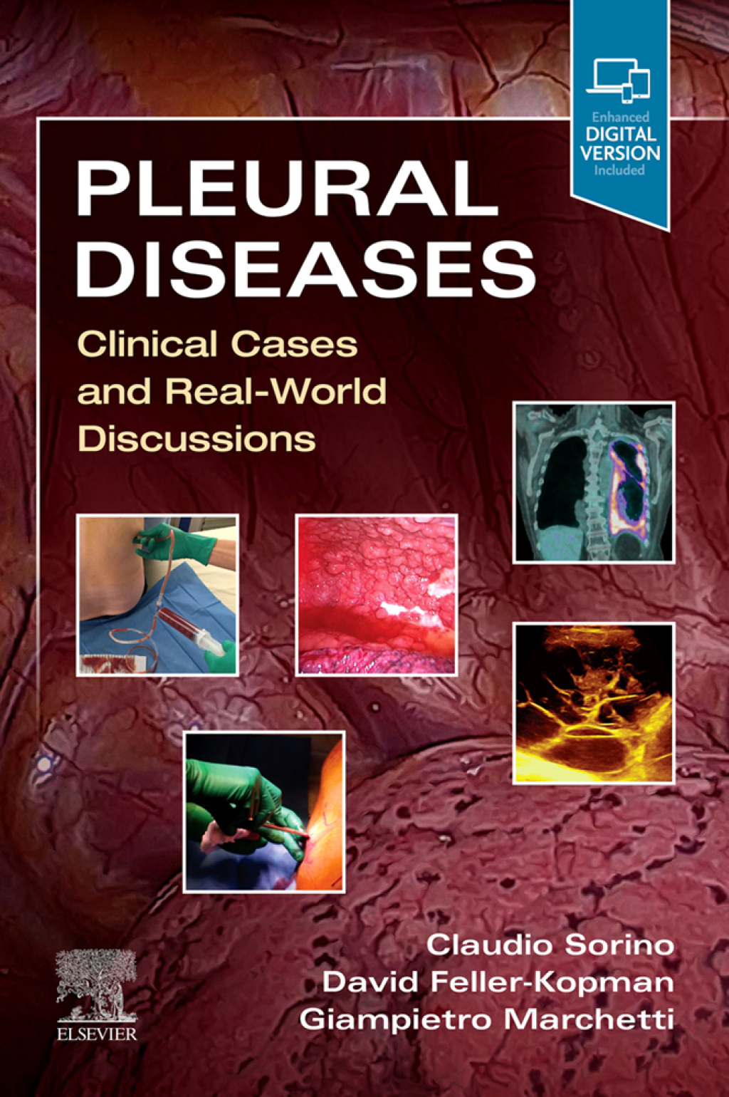 Pleural Diseases Clinical Cases and Real-World Discussions  â€“ PDF/EPUB Version Downloadable