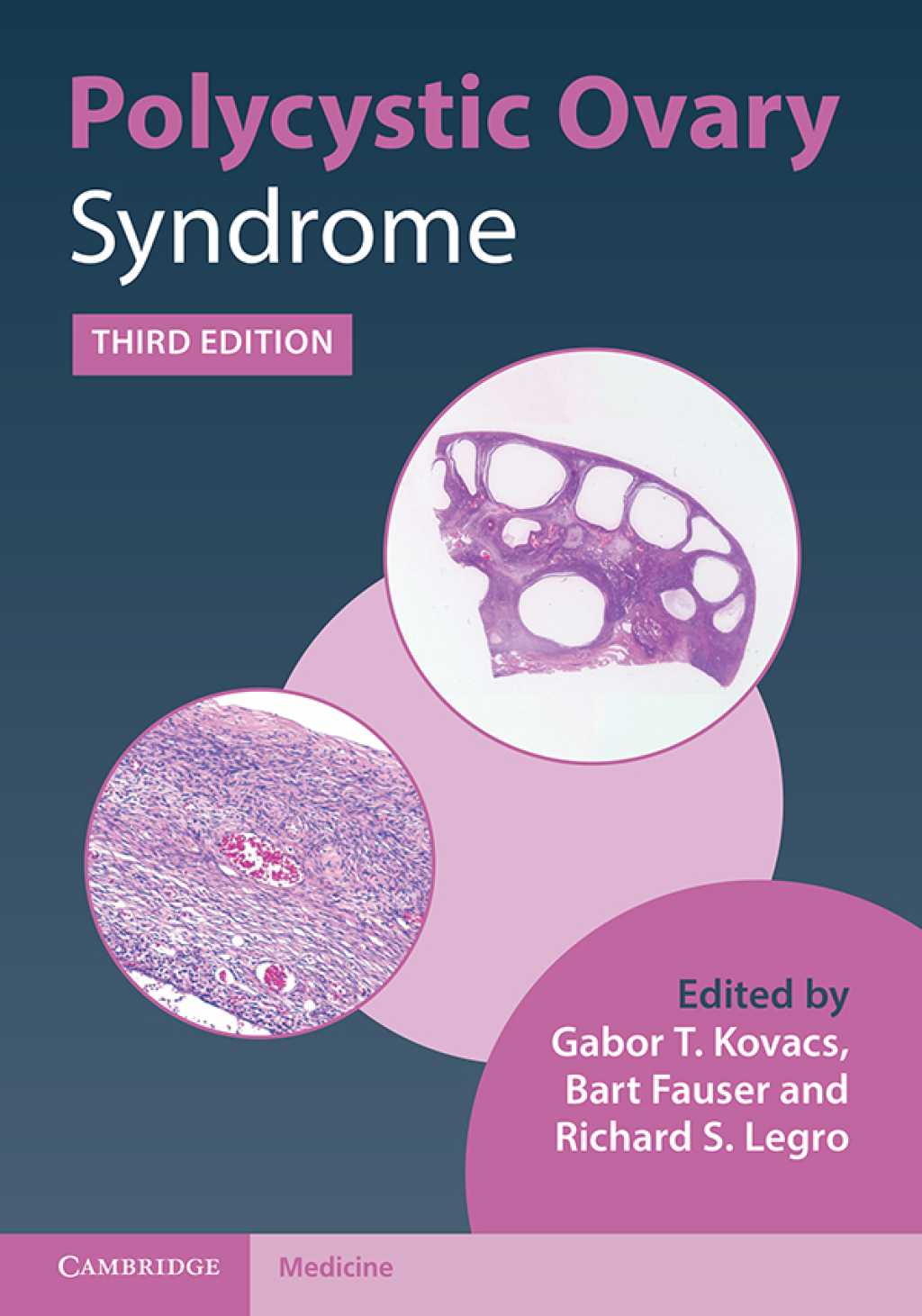 Polycystic Ovary Syndrome 3rd Edition â€“ PDF/EPUB Version Downloadable